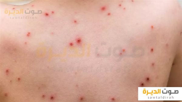 مرض جدري القرود