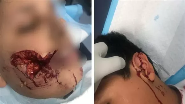 كلب ضال يهاجم طفلًا بتثليث